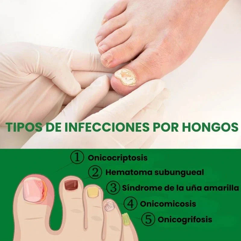 Protege y elimina el hongo de tus Uñas