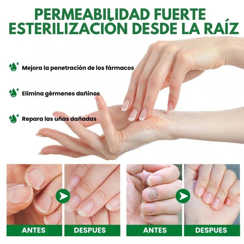 Protege y elimina el hongo de tus Uñas